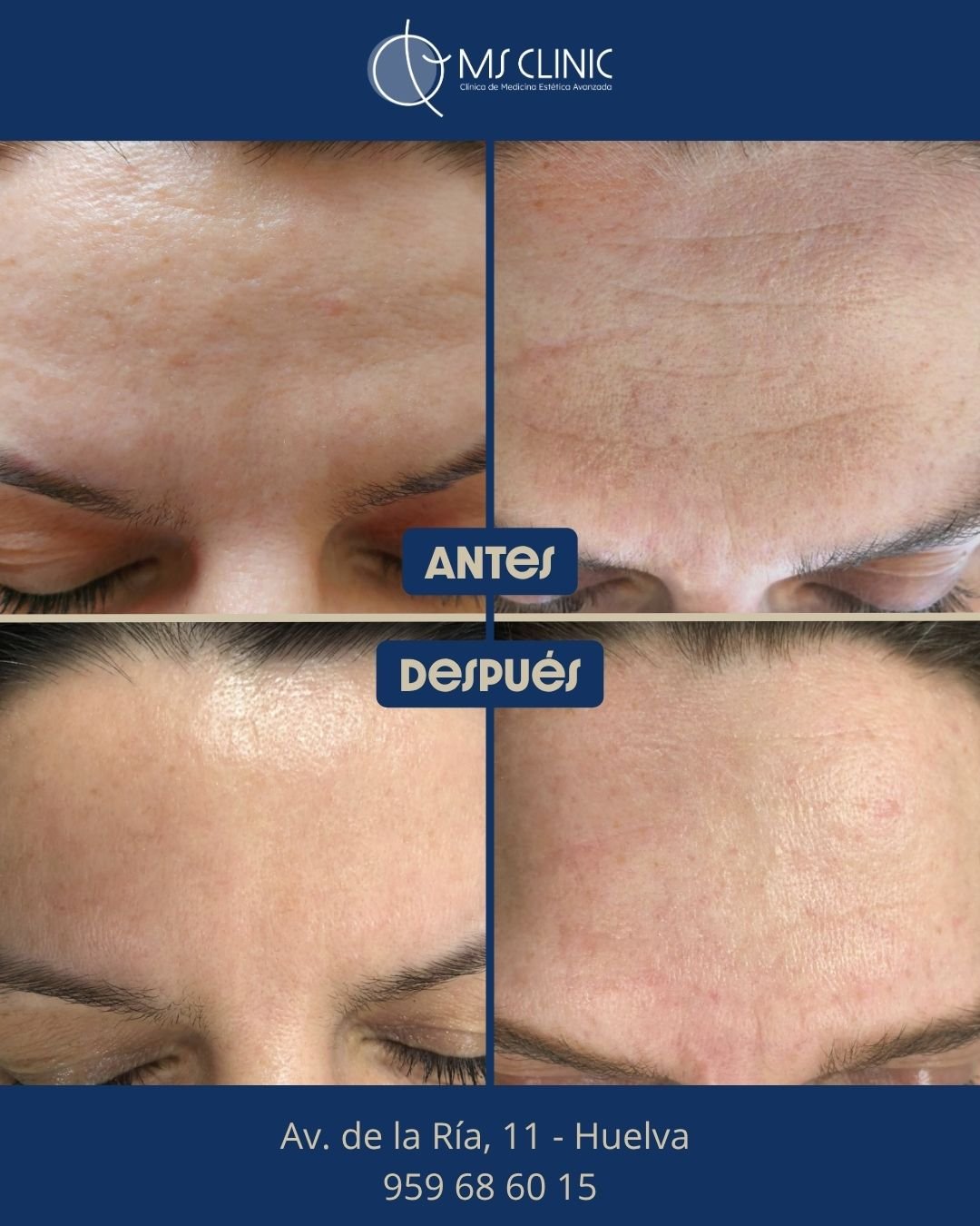 Resultado de LaserMe de Neauvia (antes y después) — MS Clinic Huelva