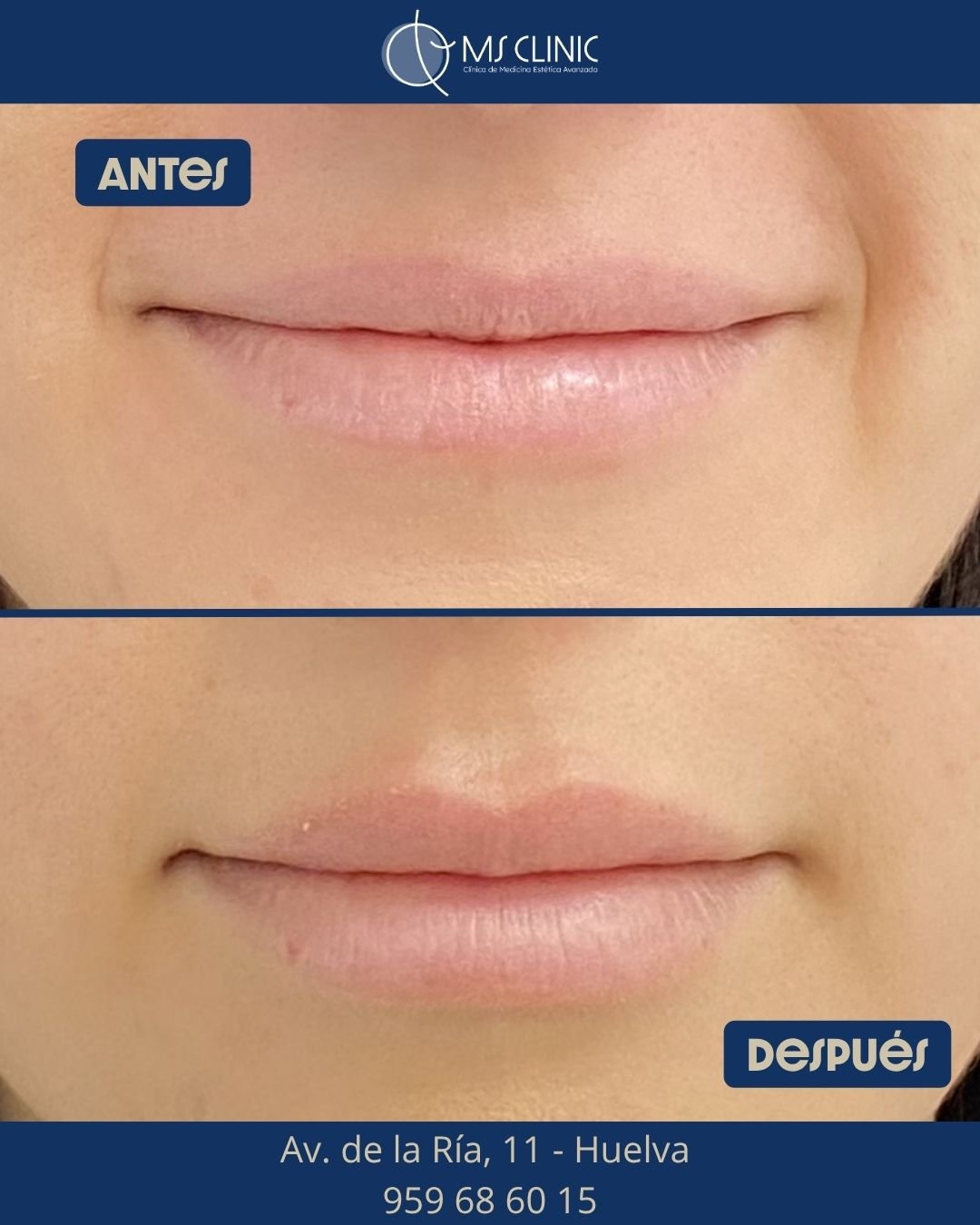 Labios antes y después con ácido hialurónico — MS Clinic Huelva
