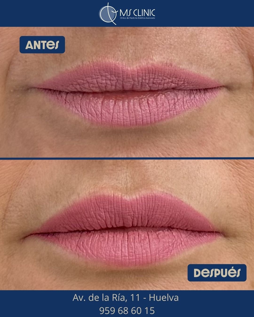 Labios antes y después con ácido hialurónico — MS Clinic Huelva