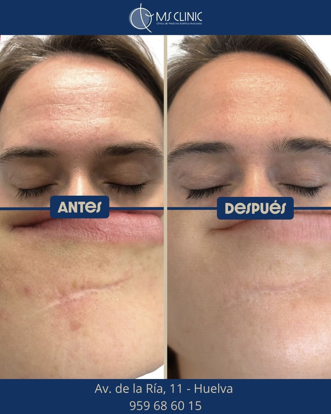 Resultado de LaserMe de Neauvia (antes y después) — MS Clinic Huelva