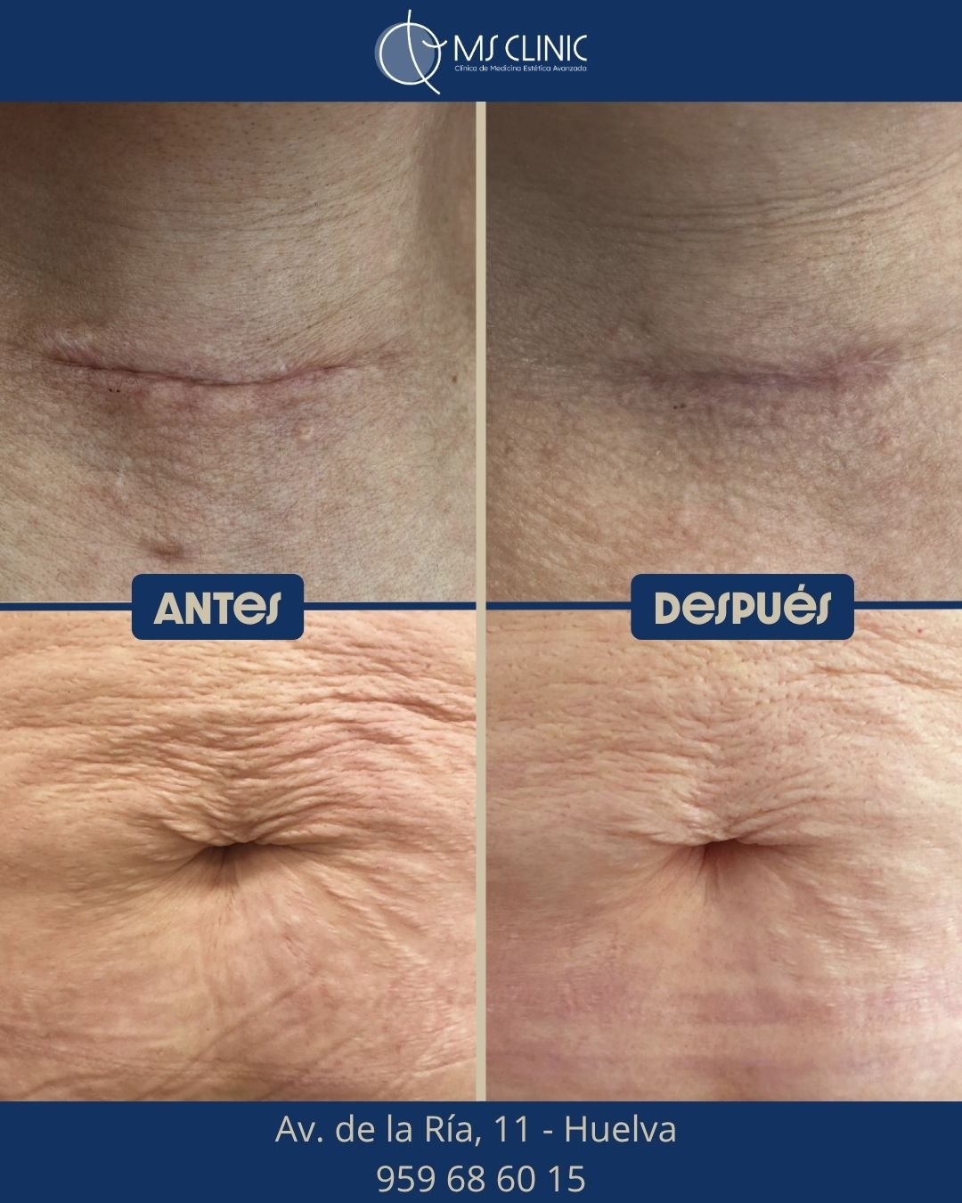 Resultado de LaserMe de Neauvia (antes y después) — MS Clinic Huelva