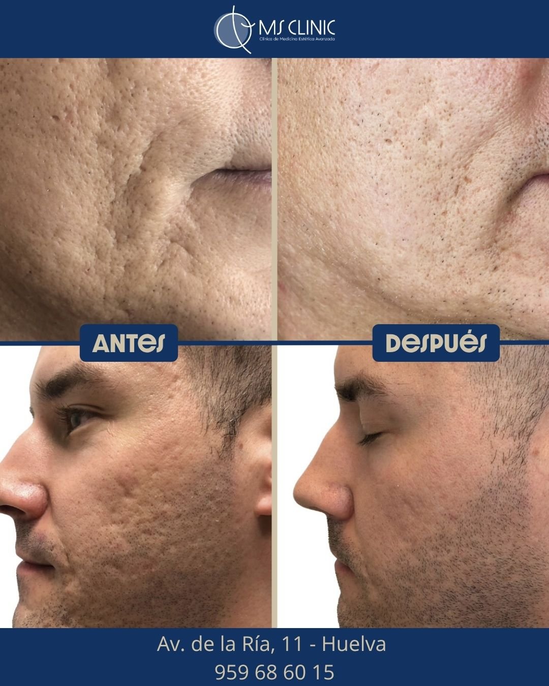 Resultado de LaserMe de Neauvia (antes y después) — MS Clinic Huelva