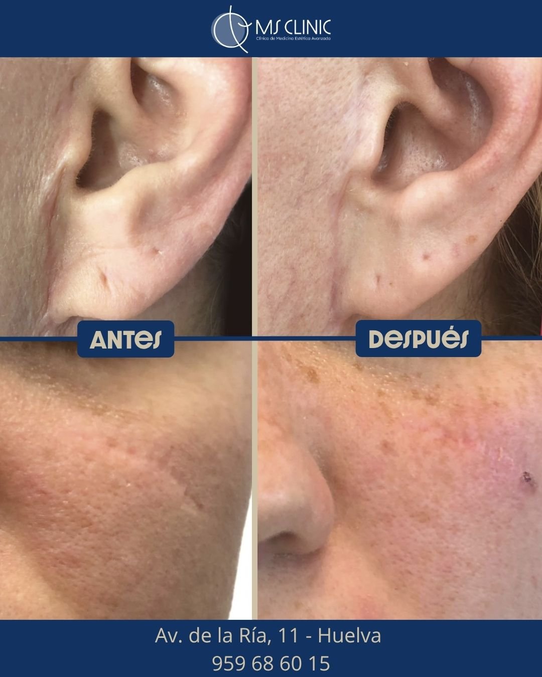 Resultado de LaserMe de Neauvia (antes y después) — MS Clinic Huelva