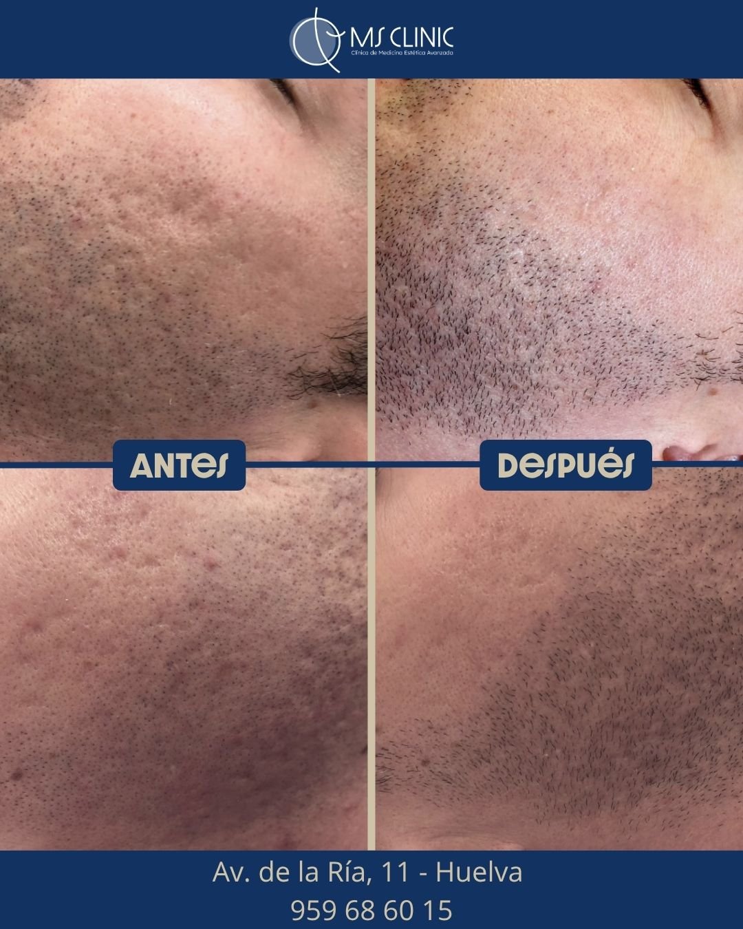 Resultado de LaserMe de Neauvia (antes y después) — MS Clinic Huelva