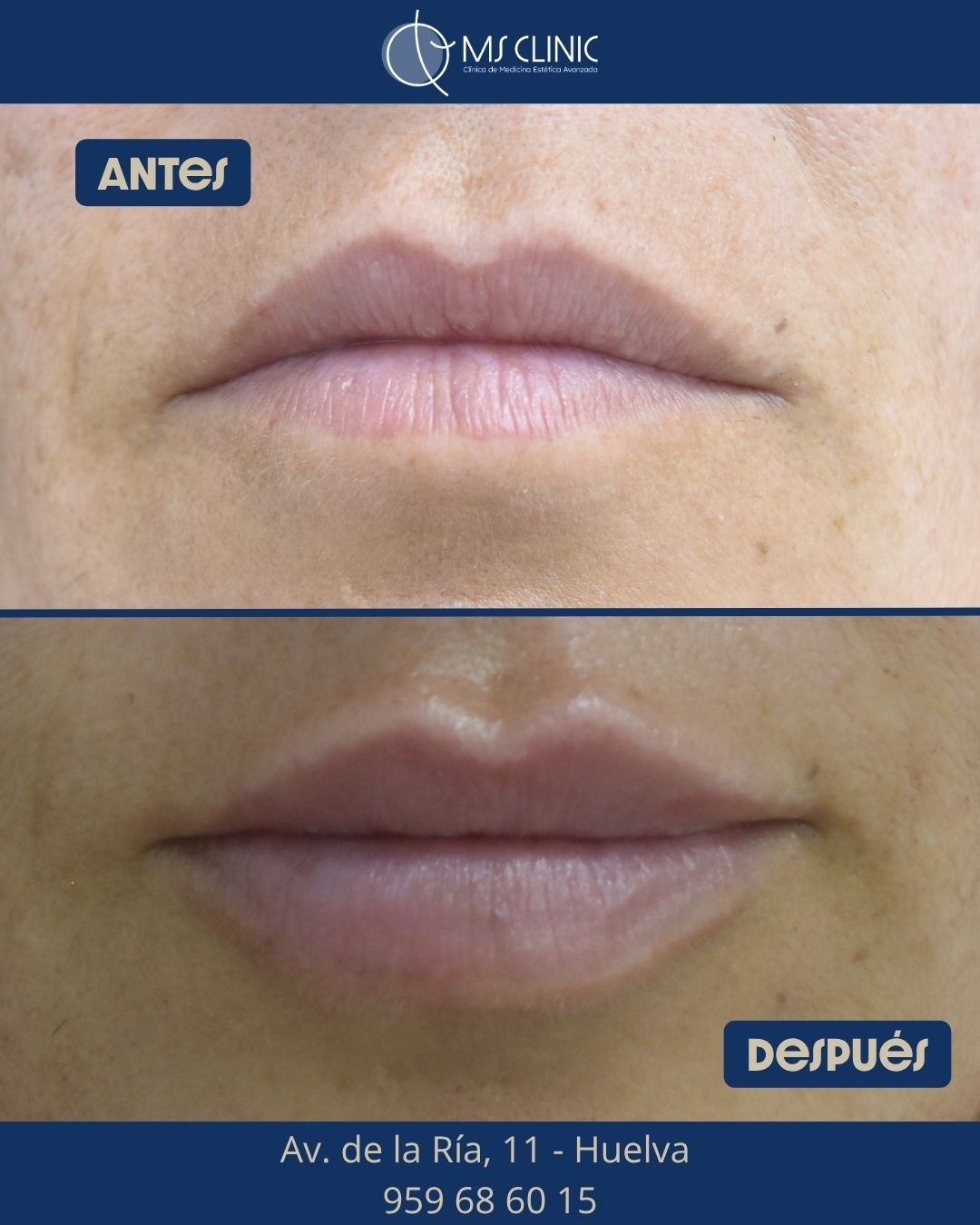 Labios antes y después con ácido hialurónico — MS Clinic Huelva