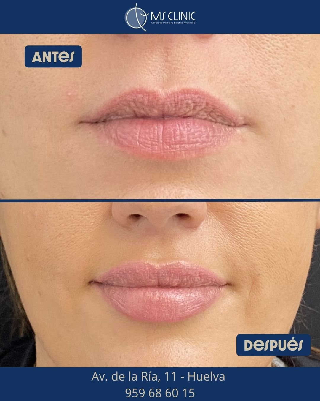 Labios antes y después con ácido hialurónico — MS Clinic Huelva