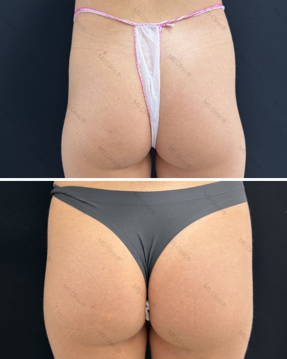 Remodelación glútea antes y después — MS Clinic Huelva