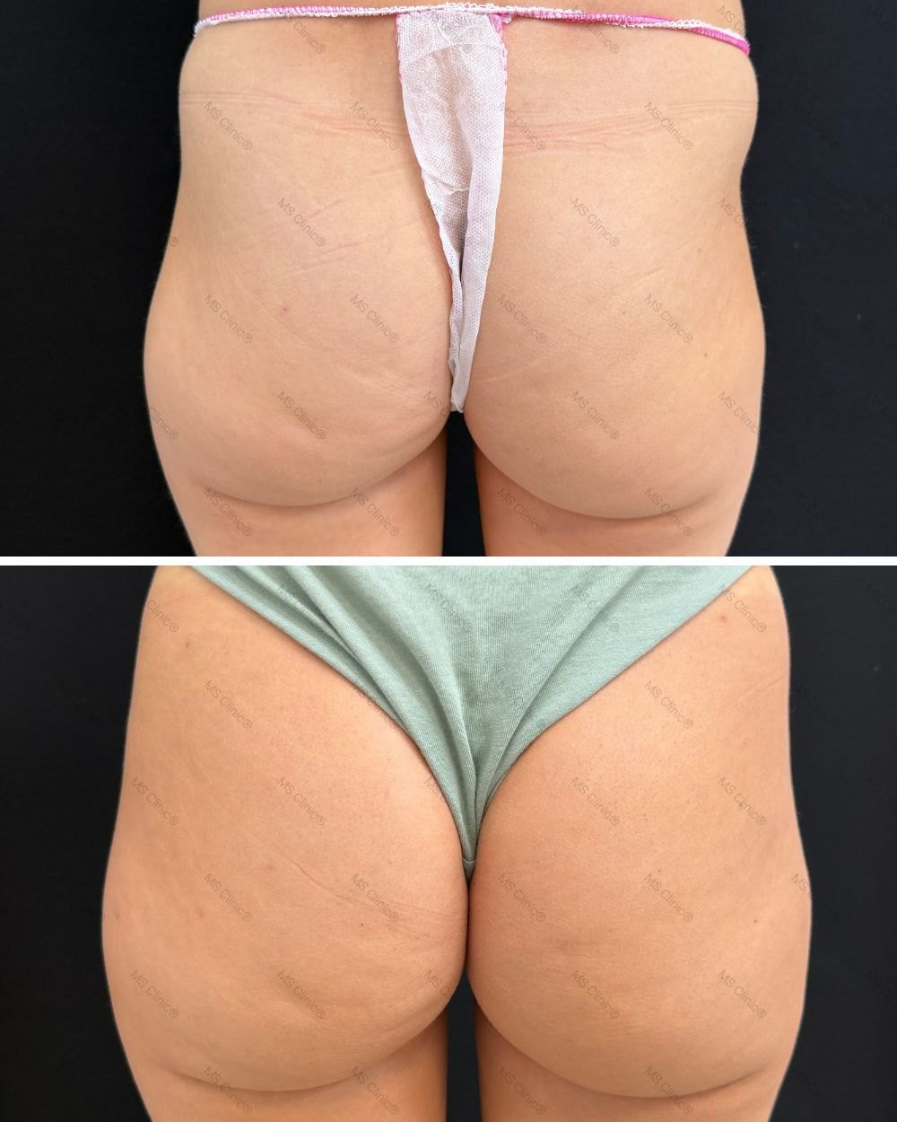 Remodelación glútea antes y después — MS Clinic Huelva