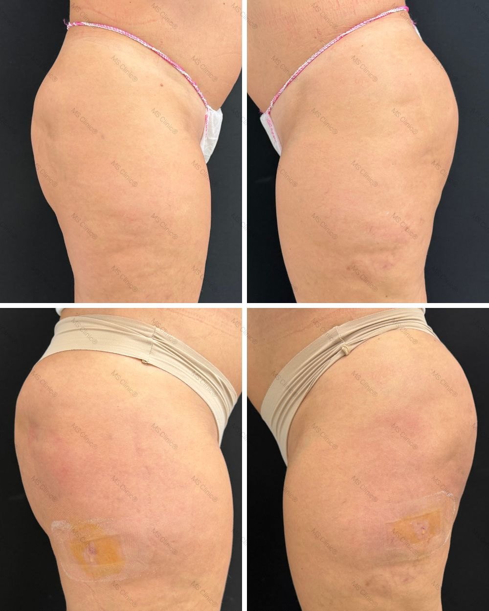 Remodelación glútea antes y después — MS Clinic Huelva